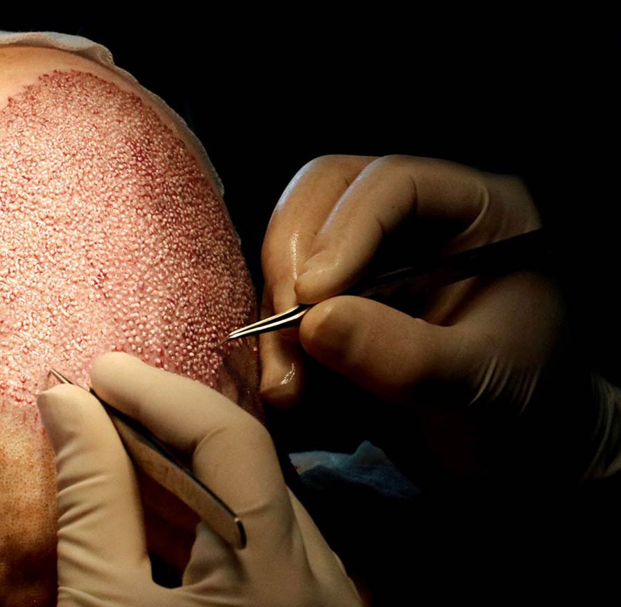 Hair Transplant Turkey Hair Transplant Turkey